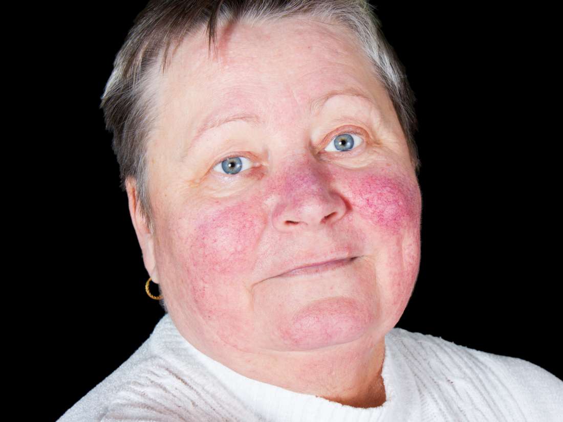 Briana Culberson's Diagnosis of Lupus And Her Weight Loss Healthyton